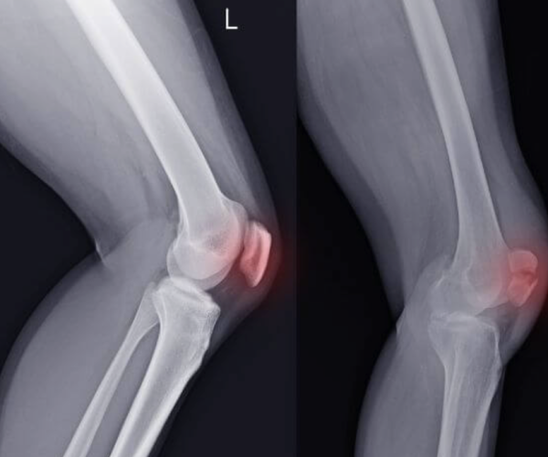 Knee Dislocation